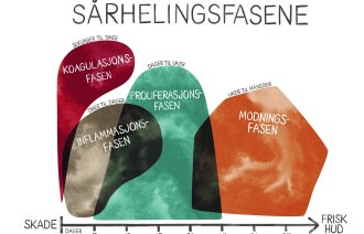 Illustrasjonen viser de fire sårhelingsfasene.