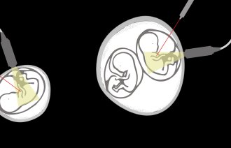 Illustrasjon som viser fosterreduksjon der det er ett embryo, og ett hvor det er to.