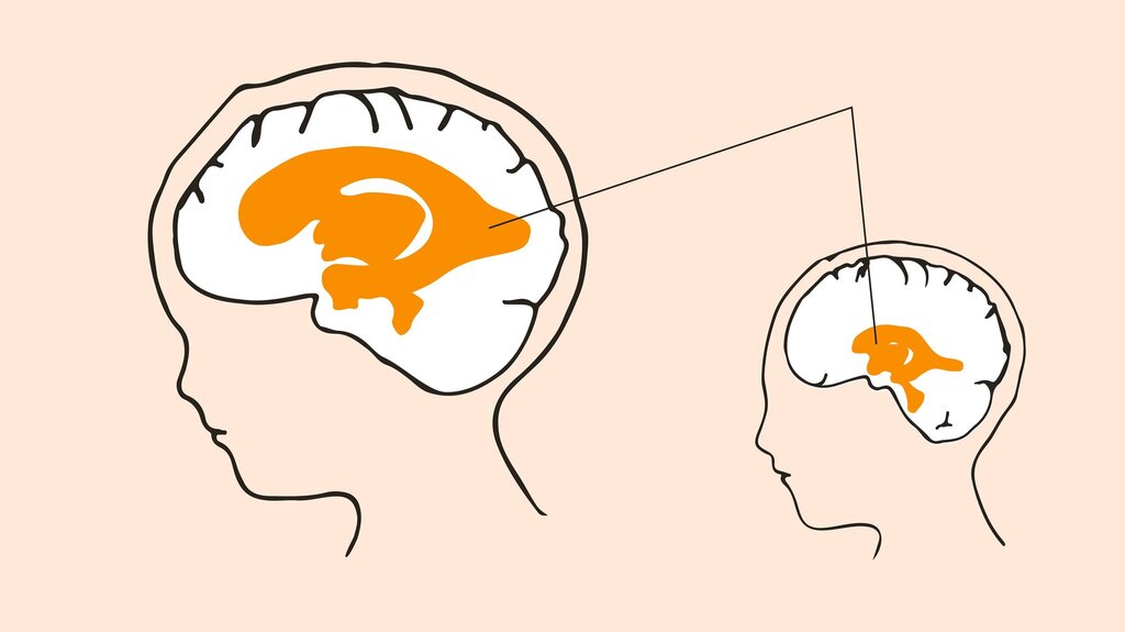 VANNHODE: Hydrocephalus (vannhode) er en tilstand med økt hjernevæske og utvidelse av hjernens naturlige hulrom, ventrikkelsystemet. Kilde: Oslo-universitetssykehus. Illustrasjon: Monica Hilsen