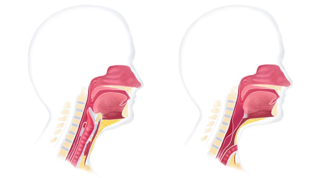 Illustrasjonen viser normal luftveisanatomi før operasjon og etter operasjon, der strupen er operert bort og luftrøret lagt frem på halsen.