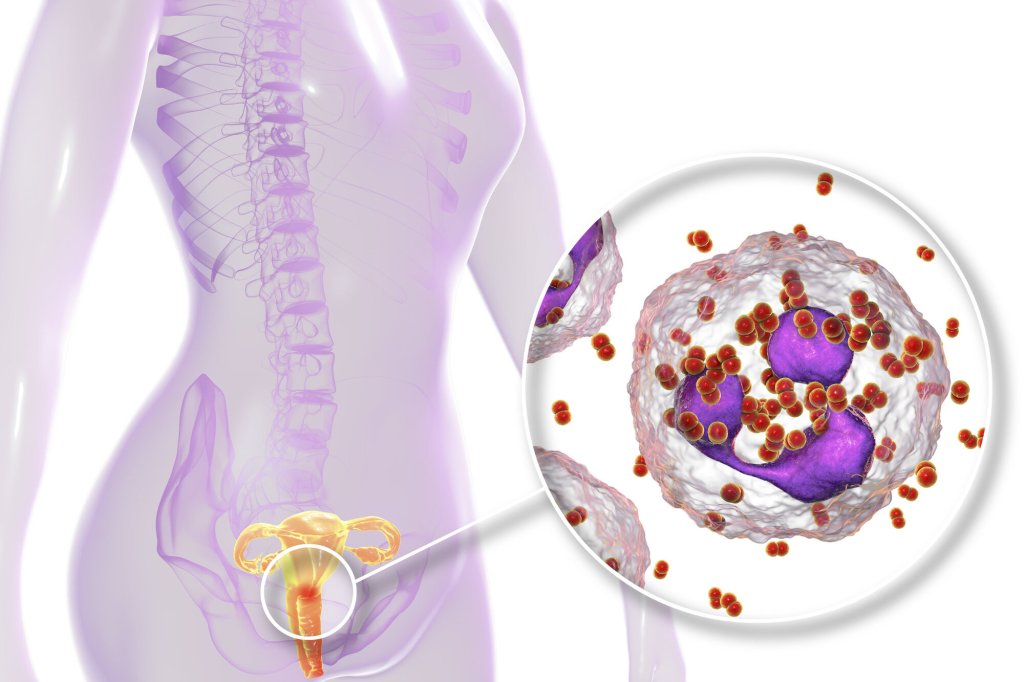Bildet er en illustrasjon som viser gonoréinfeksjon hos en kvinne. 